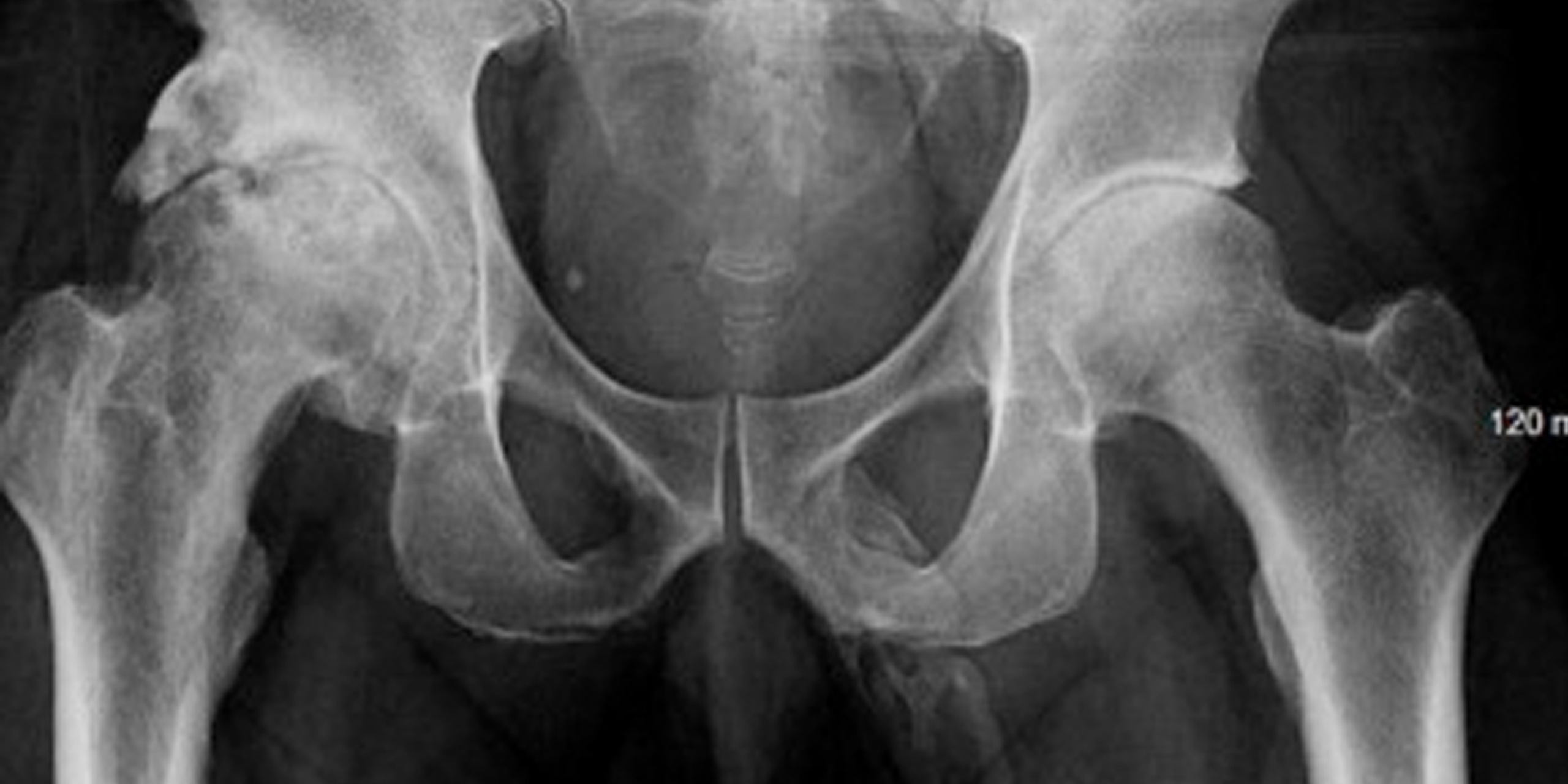 X Ray Penis Penetration